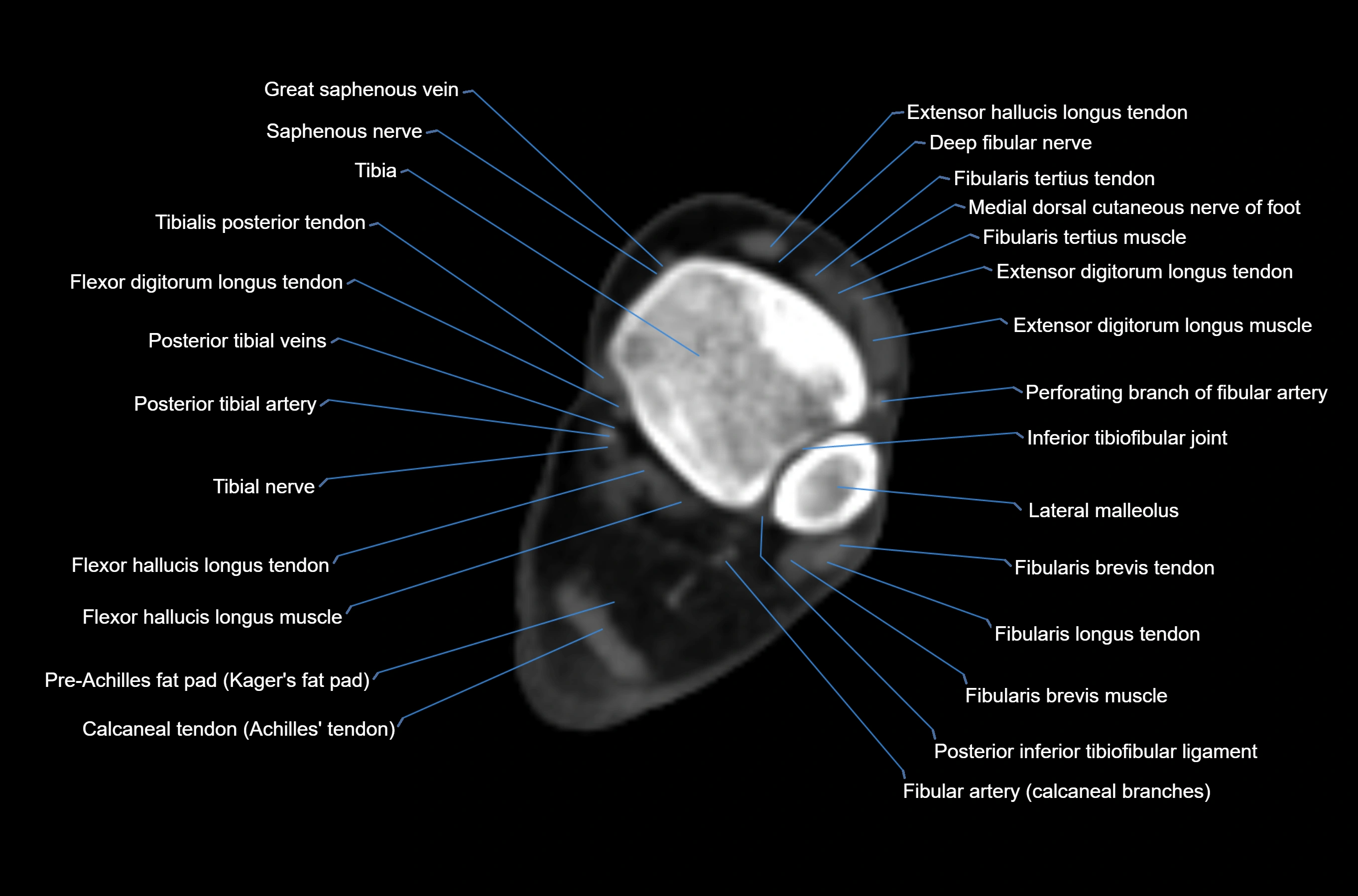 CT Ankle axial cross sectional anatomy labelled image -00026.webp